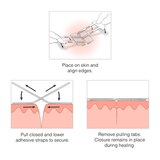 Clozex Laceration Closures, 1", 2 CT, thumbnail image 4 of 5